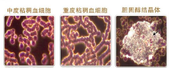 中老年预防血稠用什么药,老年人怎么关注血管