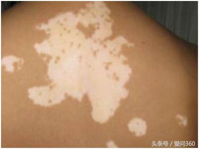 手白癜风是什么原因引起的,下身白癜风是什么原因引起的