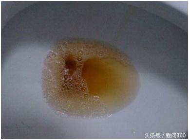 尿液发黄是不是有疾病,男性尿液腥臭发黄有泡沫