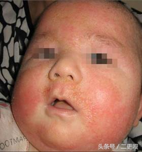 小儿湿疹最简单的自愈方法,小儿湿疹怎么治疗最有效