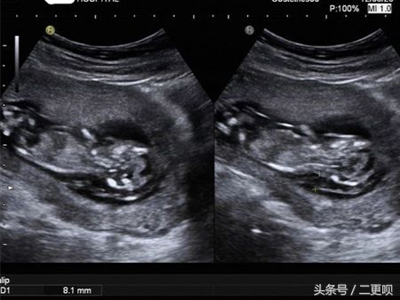 nt检查11周去还是12周去比较好,孕12-16周做nt检查需要关注什么