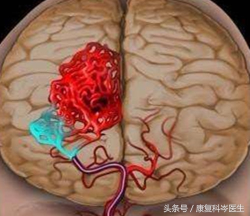 预防脑出血这5件事要做到,预防脑出血疾病又能帮助恢复的药