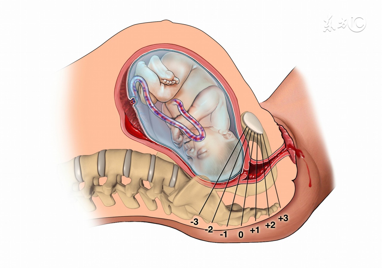 顺产侧切伤口怎么护理伤口好得快,顺产侧切伤口如何护理恢复比较快