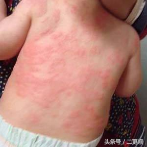 小儿湿疹最简单的自愈方法,小儿湿疹怎么治疗最有效