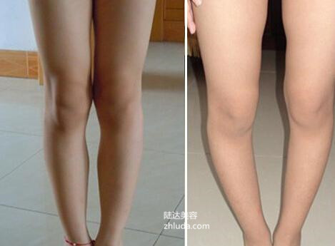 腿不直怎么矫正腿型未成年,大腿向前凸起矫正最实用的办法