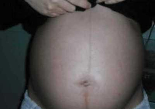 怀孕看肚子上的线准吗偏左偏右,怎么看妊娠线偏左还是偏右图片