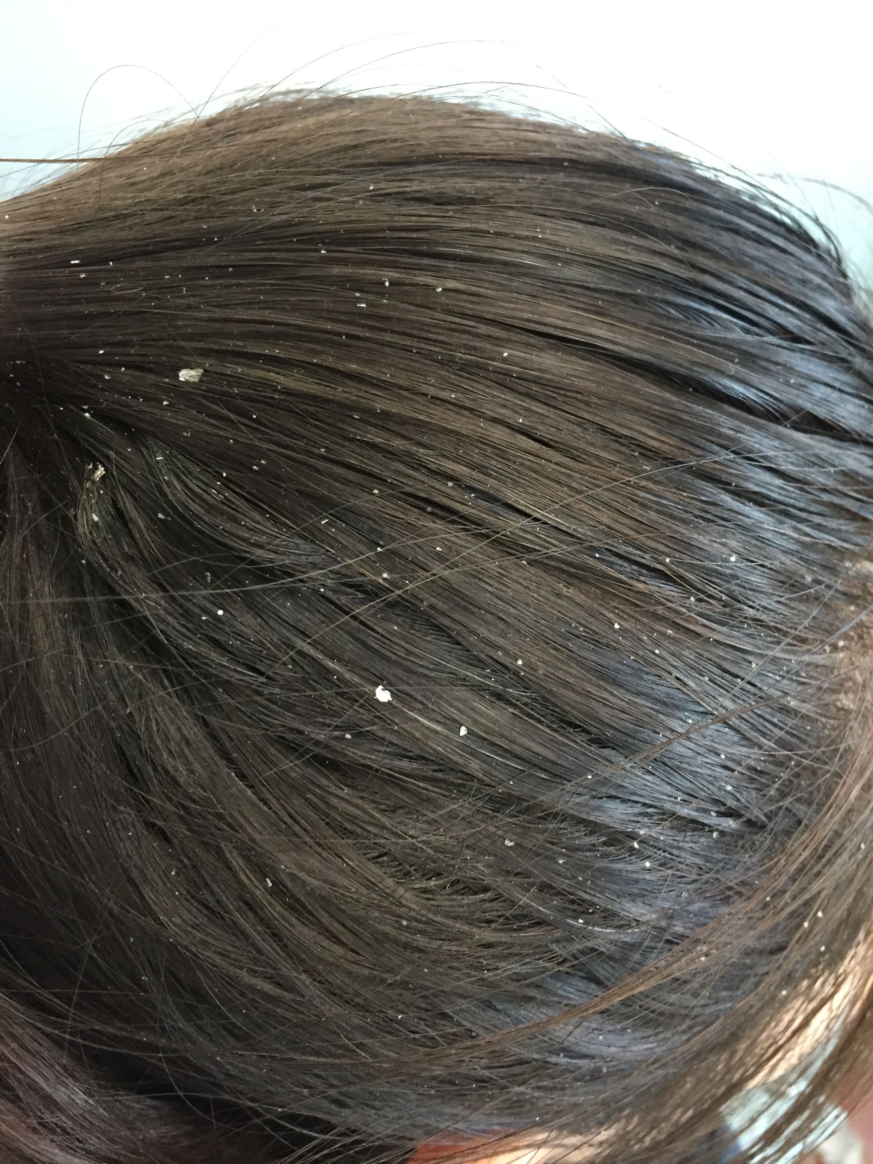 头皮发痒头皮屑多用康王也不管用,婴儿头皮屑多头皮痒用什么药