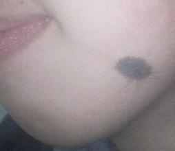 切除黑毛痣有什么危害,黑毛痣对身体的危害