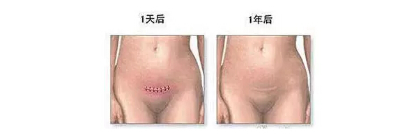 刀口恢复，剖腹产的妈妈关注啦！