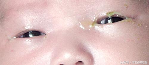 新生儿眼屎多且黄还粘稠的原因,新生儿眼屎多又黄又浓稠怎么解决