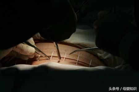 剖腹产疤痕误区,剖腹产常见的最基本的问题