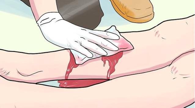 静脉曲张大出血抢救几率,下肢静脉曲张出血怎么治