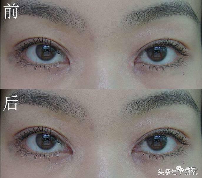为什么开眼角会变漂亮,为什么开眼角很奇怪