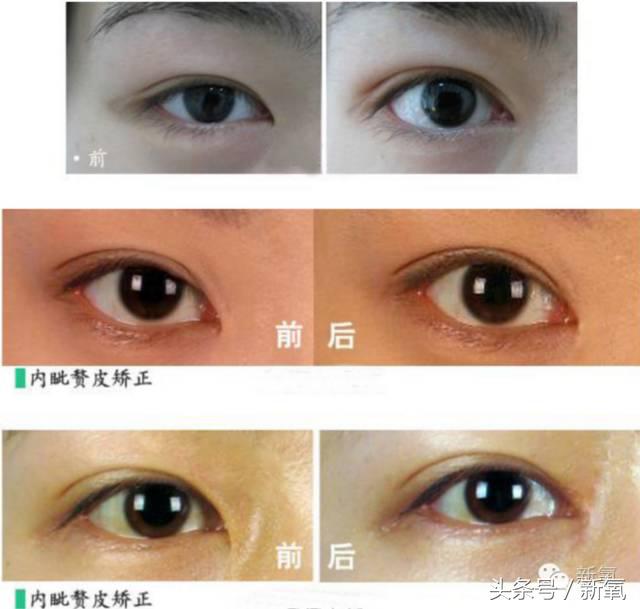 为什么开眼角会变漂亮,为什么开眼角很奇怪