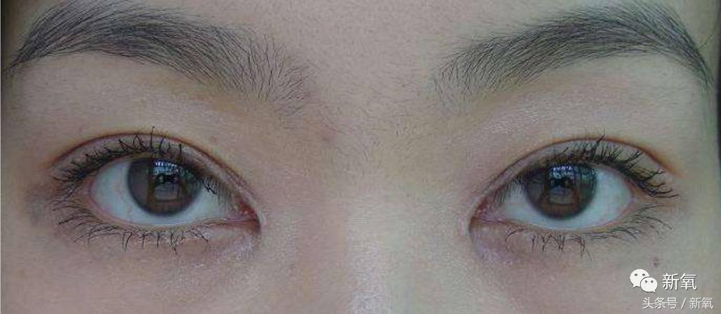 为什么开眼角会变漂亮,为什么开眼角很奇怪