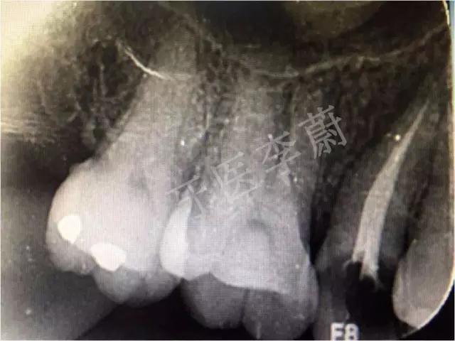 前牙残根桩冠修复,前磨牙嵌体修复
