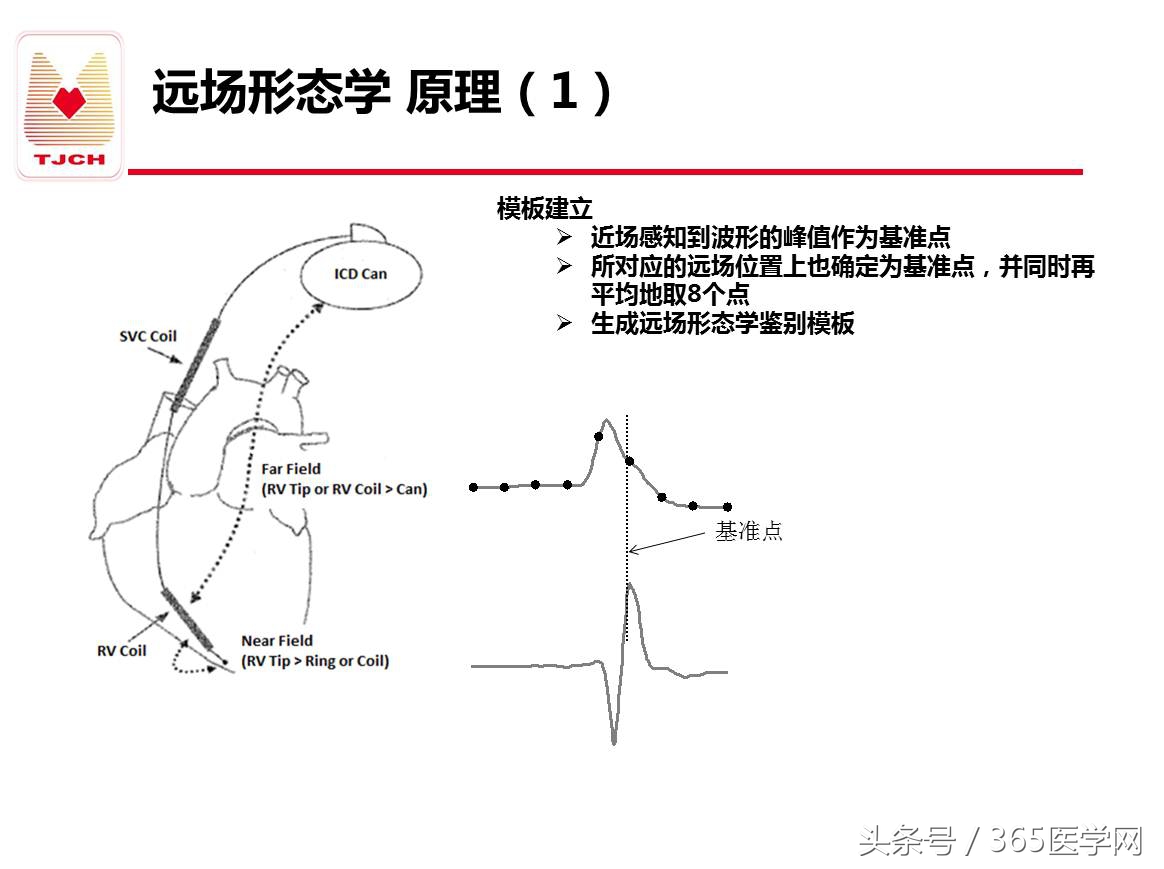 许静：新技术避免ICD不恰当放电