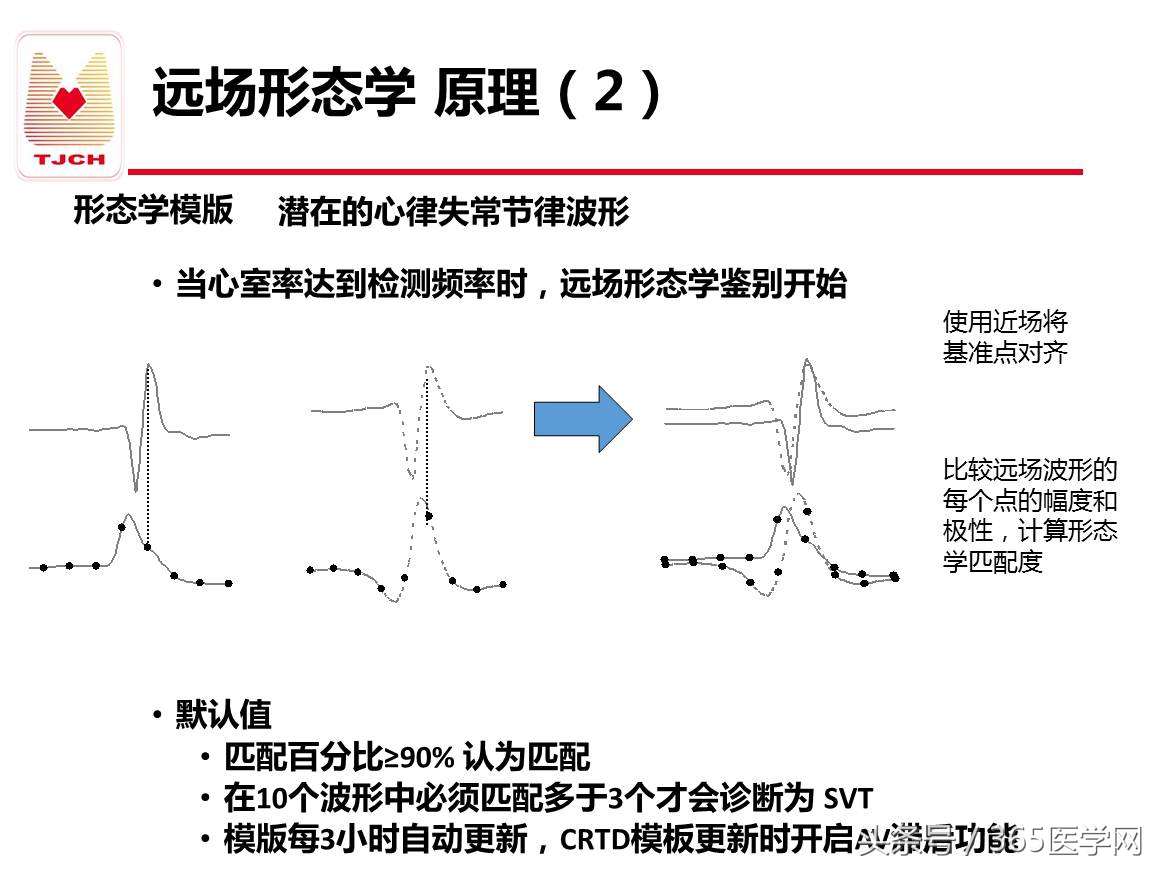 许静：新技术避免ICD不恰当放电