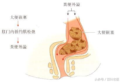 童年“屎”诗，老年“*禁失**”！如果父母大便*禁失**，你会嫌脏吗？
