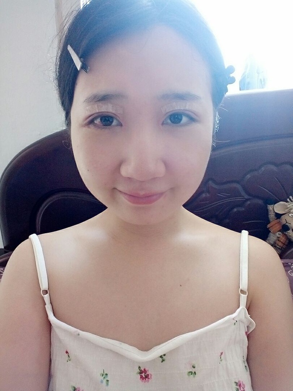 双眼皮全切手术恢复期,全切双眼皮恢复期眼尾分叉正常吗