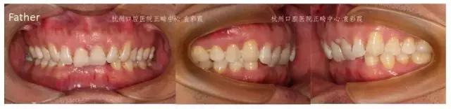 龅牙深覆合矫正效果,26岁了深覆合龅牙还能矫正吗