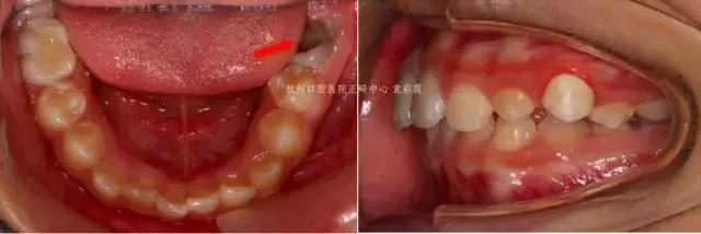 龅牙深覆合矫正效果,26岁了深覆合龅牙还能矫正吗