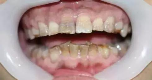 龅牙深覆合矫正效果,26岁了深覆合龅牙还能矫正吗