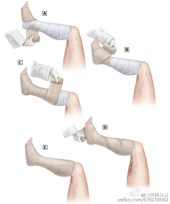 静脉曲张引发溃疡怎么治疗,如何治疗静脉曲张引起的溃疡