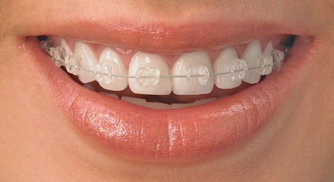 最新最安全有效的牙齿矫正方法,有一口好牙的重要性
