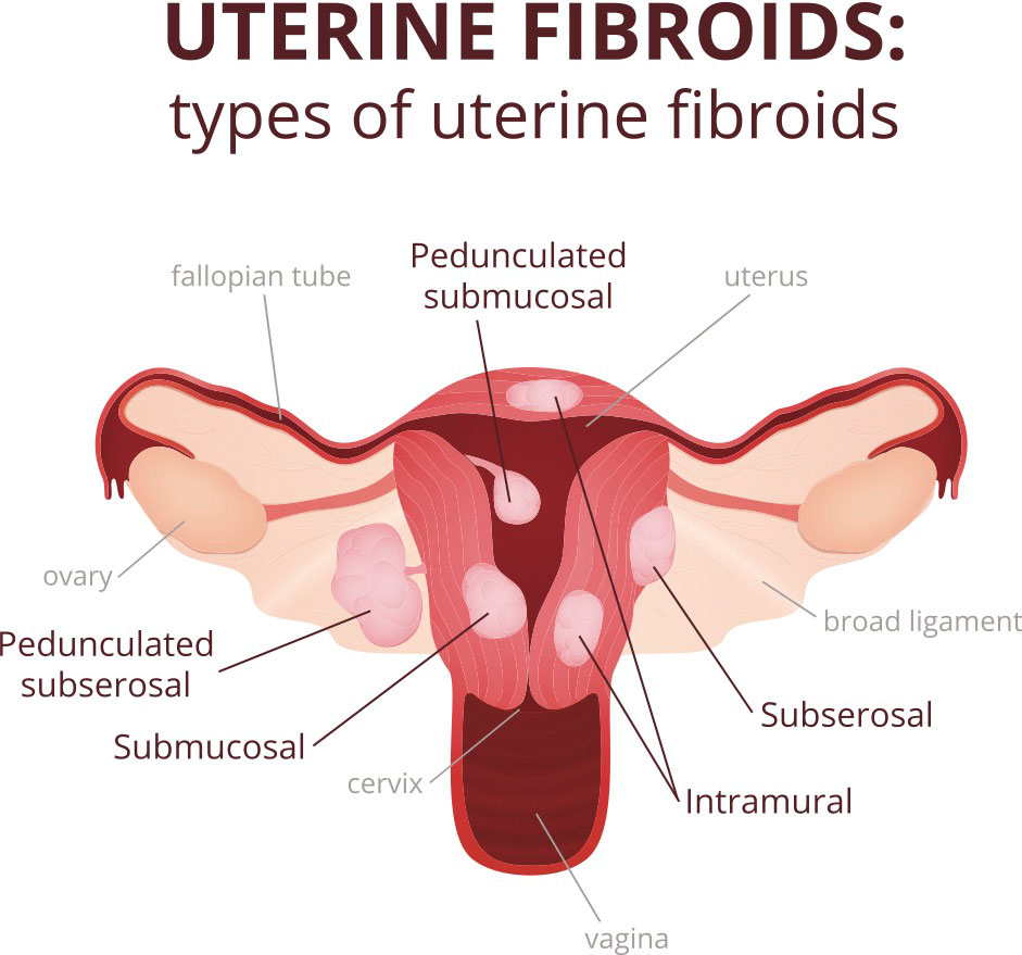 子宫肌瘤、息肉和卵巢囊肿，分别离癌症有多远？