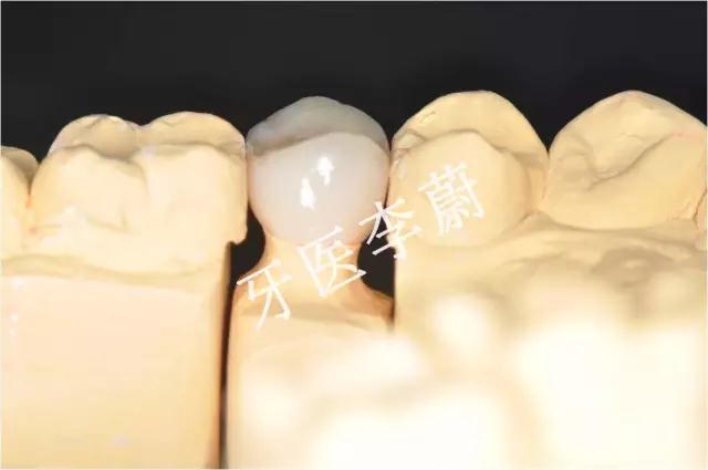 前牙残根桩冠修复,前磨牙嵌体修复