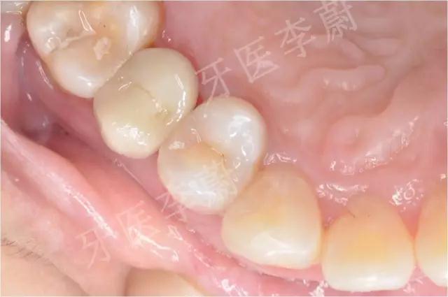 前牙残根桩冠修复,前磨牙嵌体修复