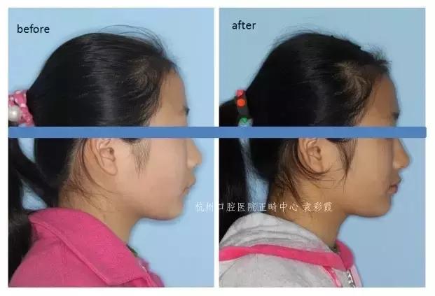 龅牙深覆合矫正效果,26岁了深覆合龅牙还能矫正吗