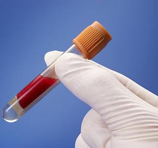 尿蛋白3+潜血3+一般是哪种肾病,糖尿病肾病潜血2+尿蛋白3加严重吗