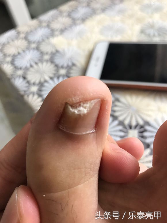 灰指甲的初期症状会传染到手上吗,脚灰指甲初期的症状