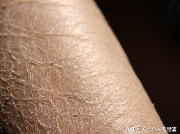 皮肤干燥综合征的症状表现,皮肤干燥发痒的表现