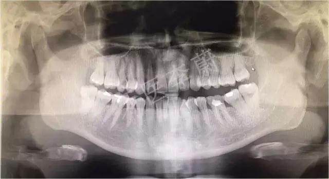 前牙残根桩冠修复,前磨牙嵌体修复