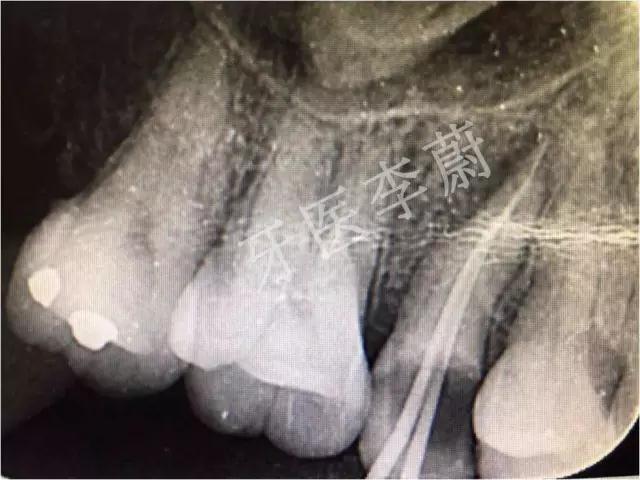 前牙残根桩冠修复,前磨牙嵌体修复