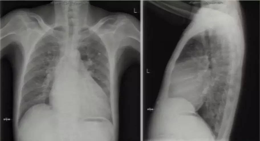 心脏增大引发的心衰能治好吗,急性心衰引起心脏扩大能治愈吗