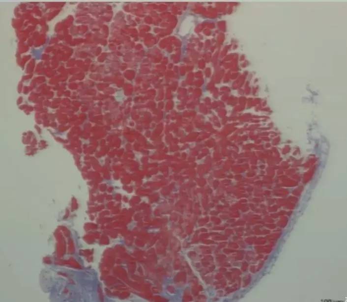 心脏增大引发的心衰能治好吗,急性心衰引起心脏扩大能治愈吗