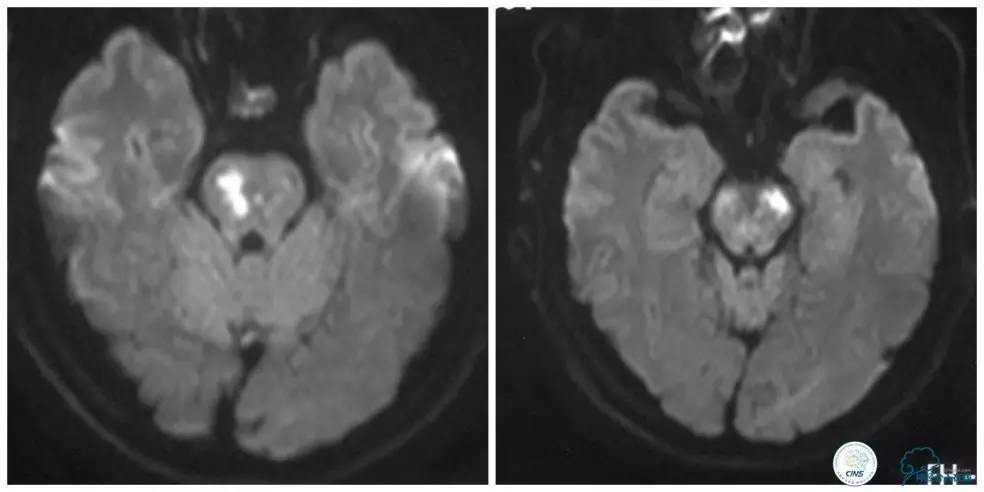 天坛周记｜右椎动脉V1段及V4-基底动脉串联病变支架治疗一例