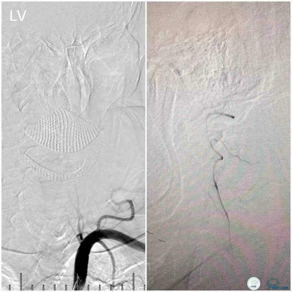 天坛周记｜右椎动脉V1段及V4-基底动脉串联病变支架治疗一例