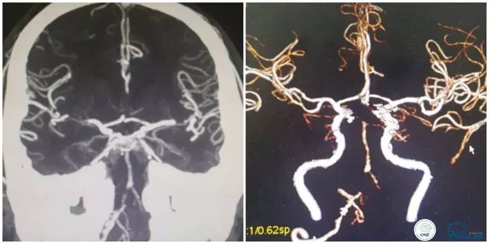 天坛周记｜右椎动脉V1段及V4-基底动脉串联病变支架治疗一例
