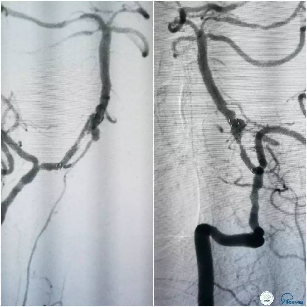 天坛周记｜右椎动脉V1段及V4-基底动脉串联病变支架治疗一例