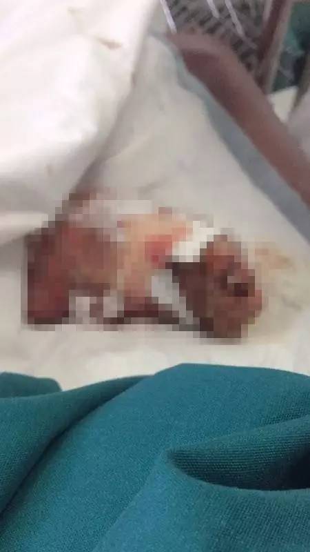 妈妈残疾爸爸瘫痪,妈妈股骨头坏死