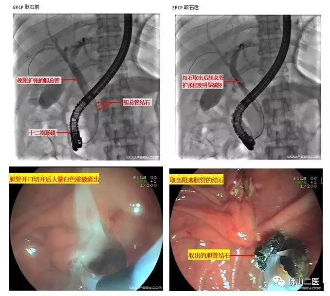 胆道感染引起的发烧怎么办,胆道感染发烧怎么治疗
