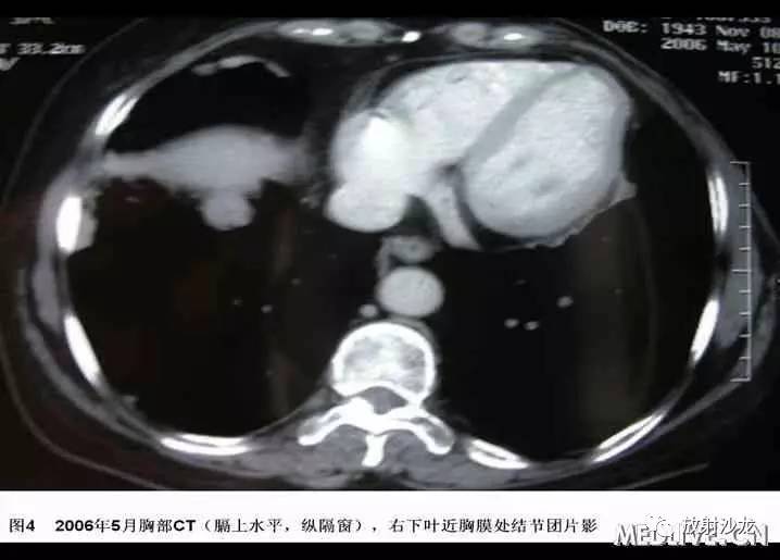 双肺实性小结节考虑炎症肉芽肿,双肺多发恶性肺结节100多个