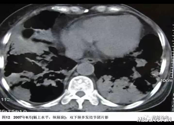 双肺实性小结节考虑炎症肉芽肿,双肺多发恶性肺结节100多个