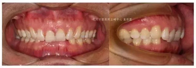 龅牙深覆合矫正效果,26岁了深覆合龅牙还能矫正吗