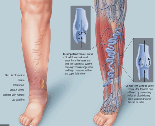 有静脉曲张要吃什么预防比较好,肝硬化静脉曲张吃什么食物最好